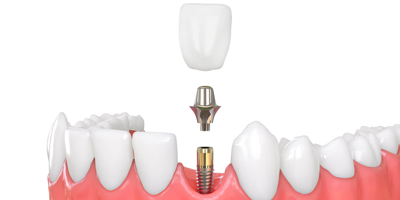 Wat zijn implantaten? 