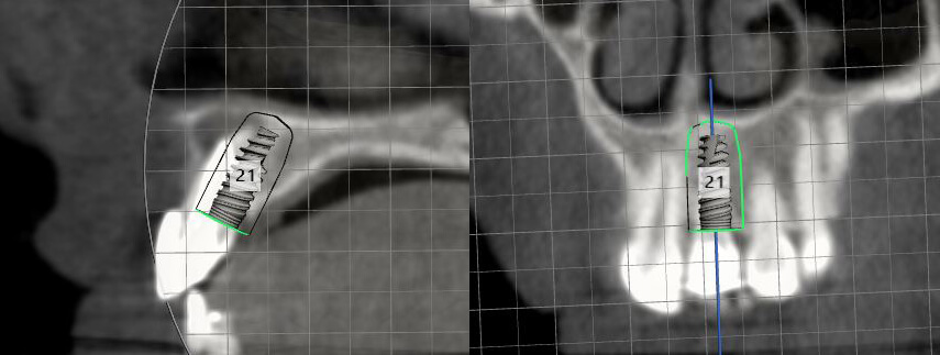 3D cone-beam CT scan